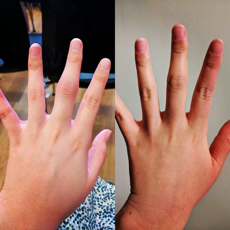 Hiro的手指，因类风湿性关节炎而关节肿胀